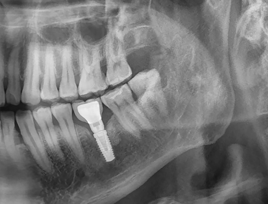  Ostéointégration et santé osseuse : pourquoi votre os est essentiel pour l’implant dentaire