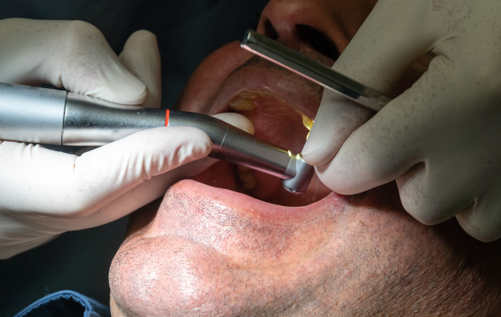 Dental Implants for Patients with Anxiety Disorders