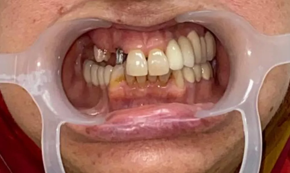 Qui peut bénéficier d’un implant dentaire à Casablanca ? Guide complet pour les patients