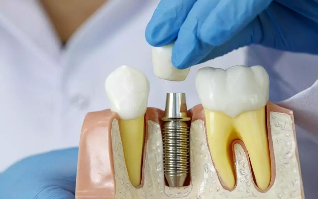 Implants dentaires au Maroc : tout ce que vous devez savoir avant de vous lancer