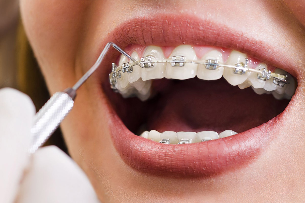 Orthodontie au Maroc : aligner ses dents avant ou après des implants dentaires ?
