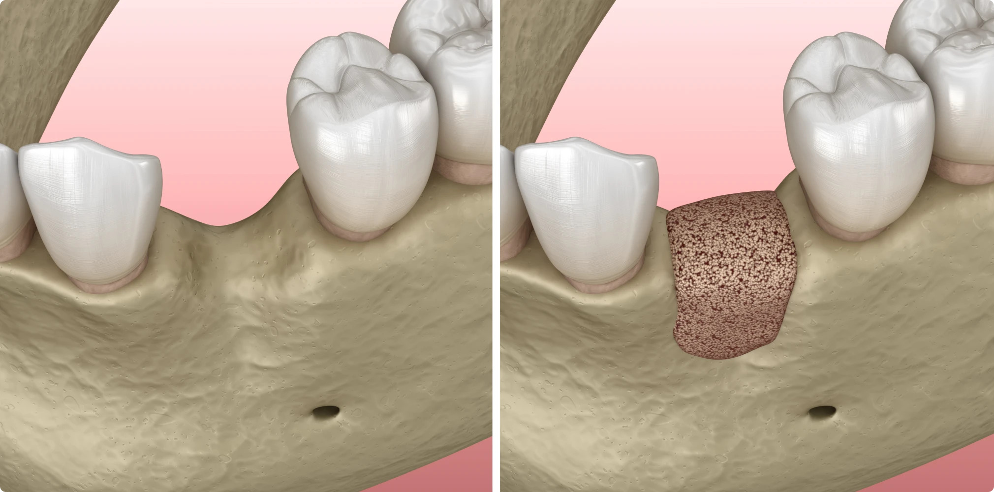 Augmentation Osseuse Avancée : Solutions Professionnelles pour Implants Dentaires