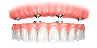 Les différentes étapes d’un implant dentaire à Casablanca : Guide complet pour les patients
