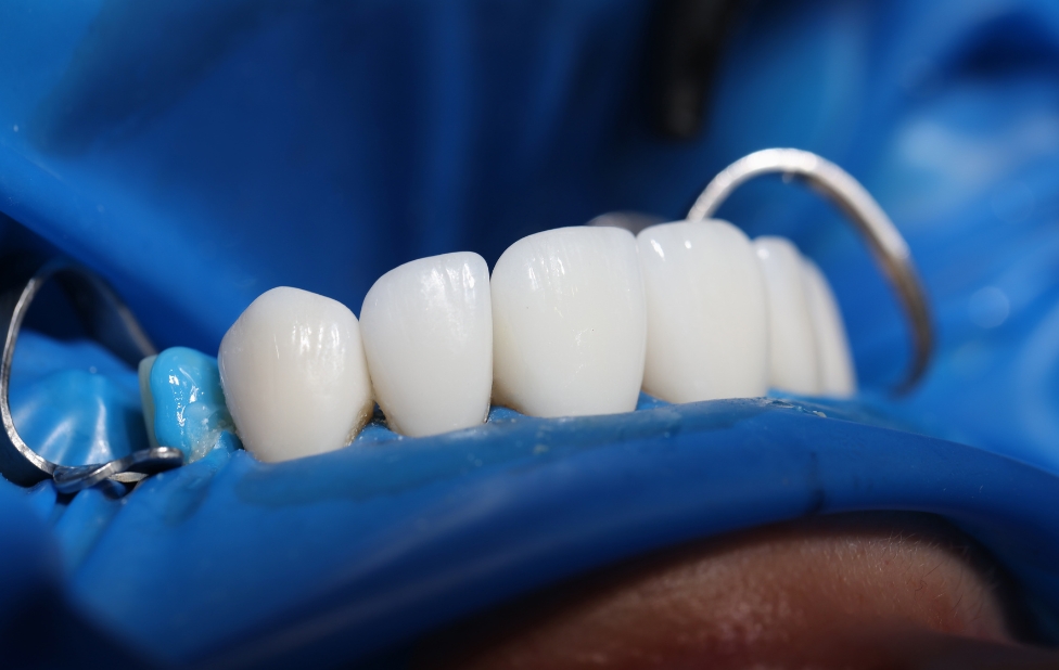 Implants dentaires au Maroc et comment retrouver un sourire naturel et durable ?