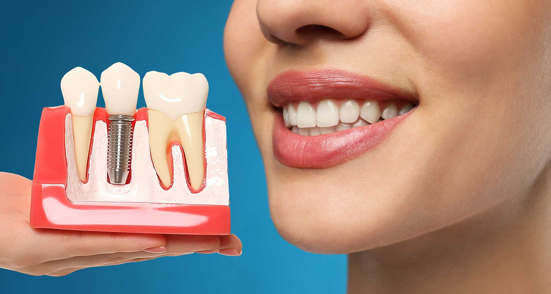 Implant dentaire au Maroc : la solution durable pour retrouver un sourire naturel