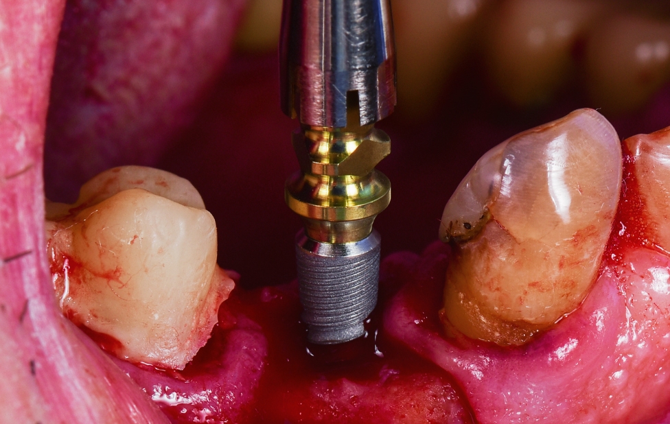 Infections péri-implantaires, détection précoce et traitement pour protéger vos implants