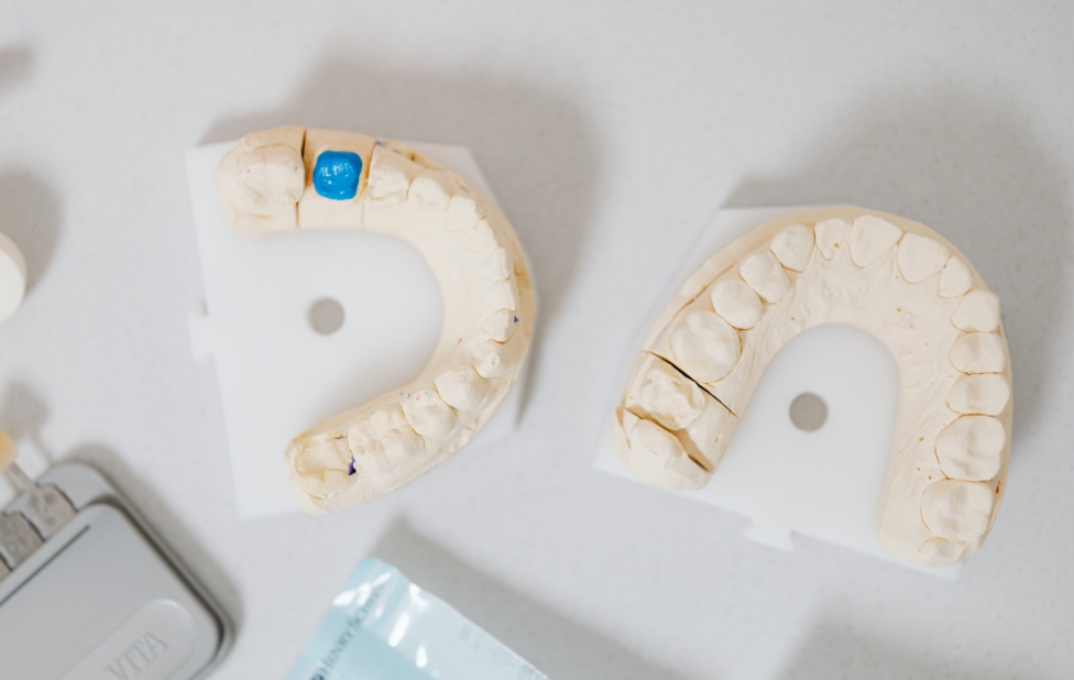 Où Faire Vos Implants Dentaires à Casablanca en 2025 ?