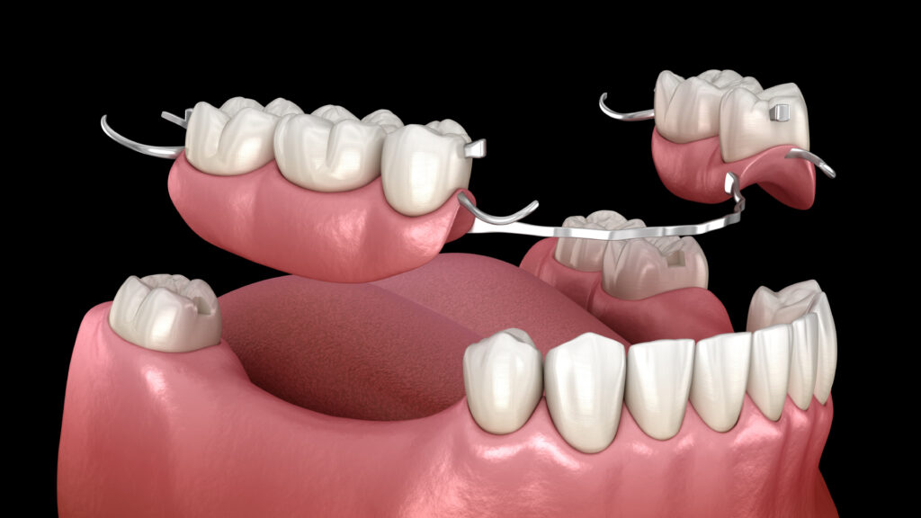 PÉRI-IMPLANTITE: PRÉVENTION, SYMPTÔMES ET TRAITEMENT