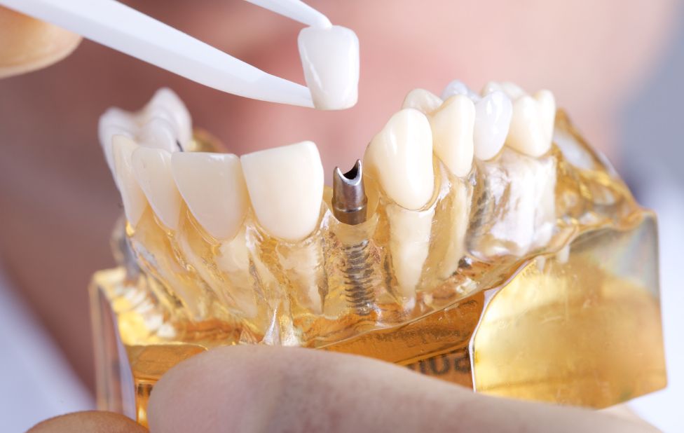 Combien coûte un implant dentaire au Maroc en 2025 ?