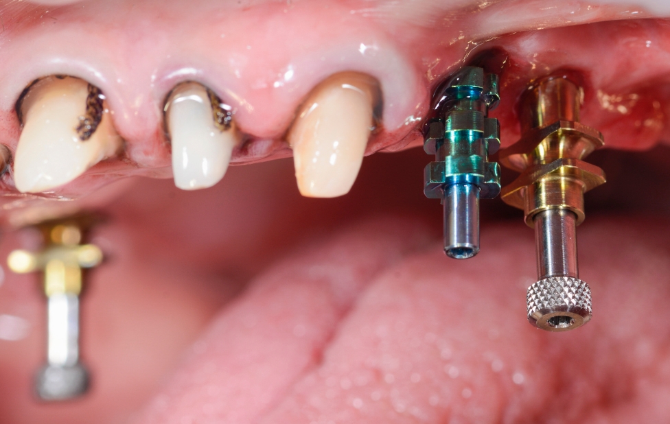 Smoking and Dental Implants: Can Long-Term Success Be Guaranteed?