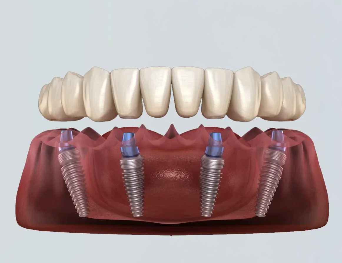 Prix des implants dentaires à Casablanca : ce qu’il faut savoir