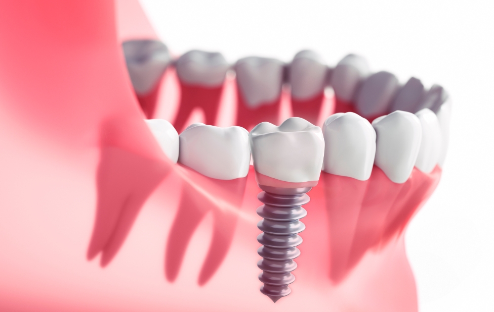 Tarifs des implants dentaires à Casablanca : tout ce qu’il faut savoir