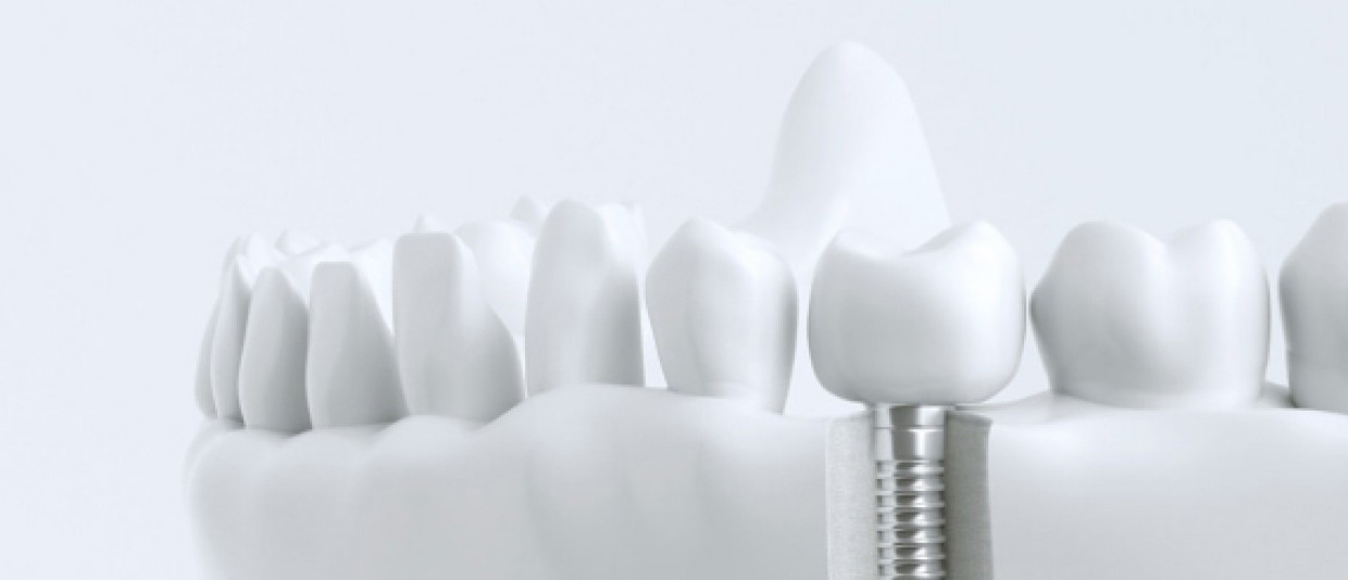 Comment se préparer à la chirurgie implantaire : conseils préopératoires pour les patients à Casablanca