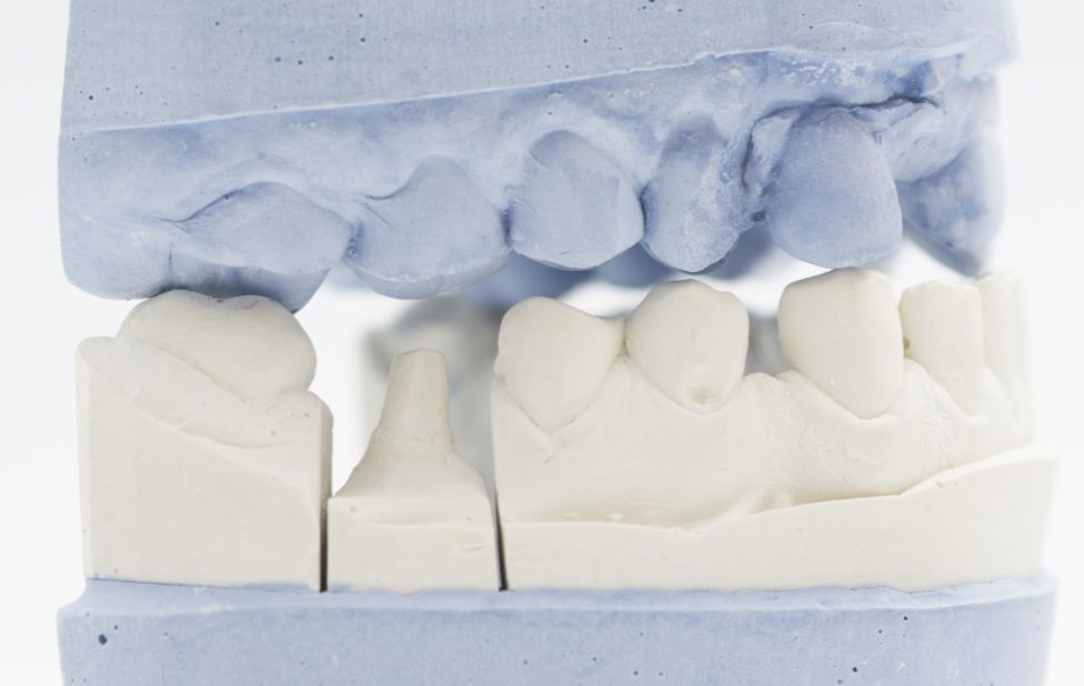 Conseils de préparation avant la pose d’un implant dentaire