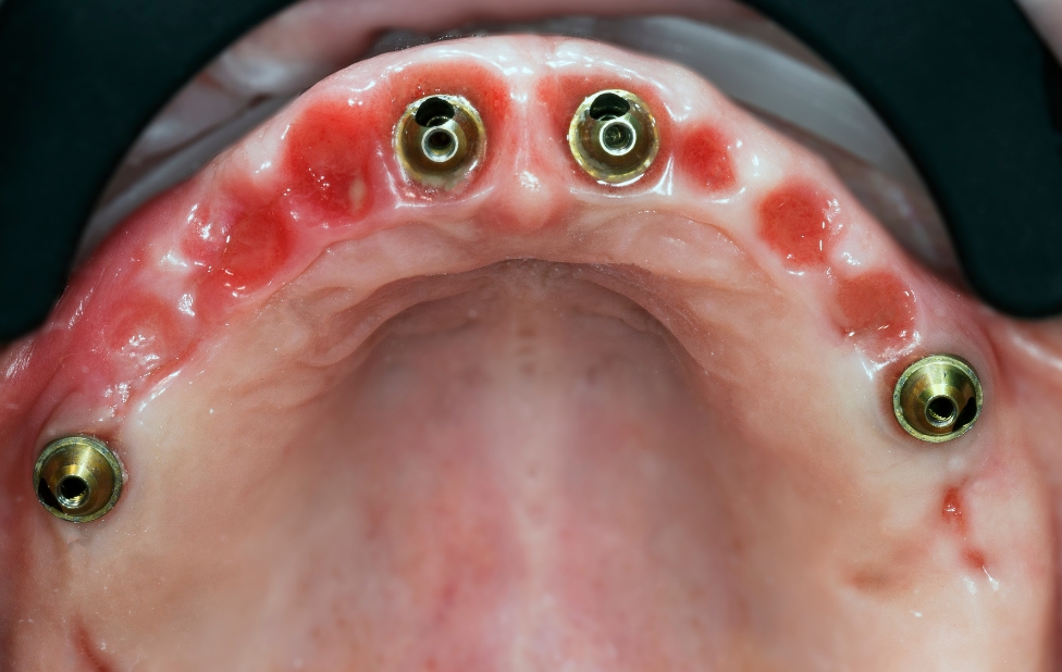 Peri-implant infections early detection and treatment