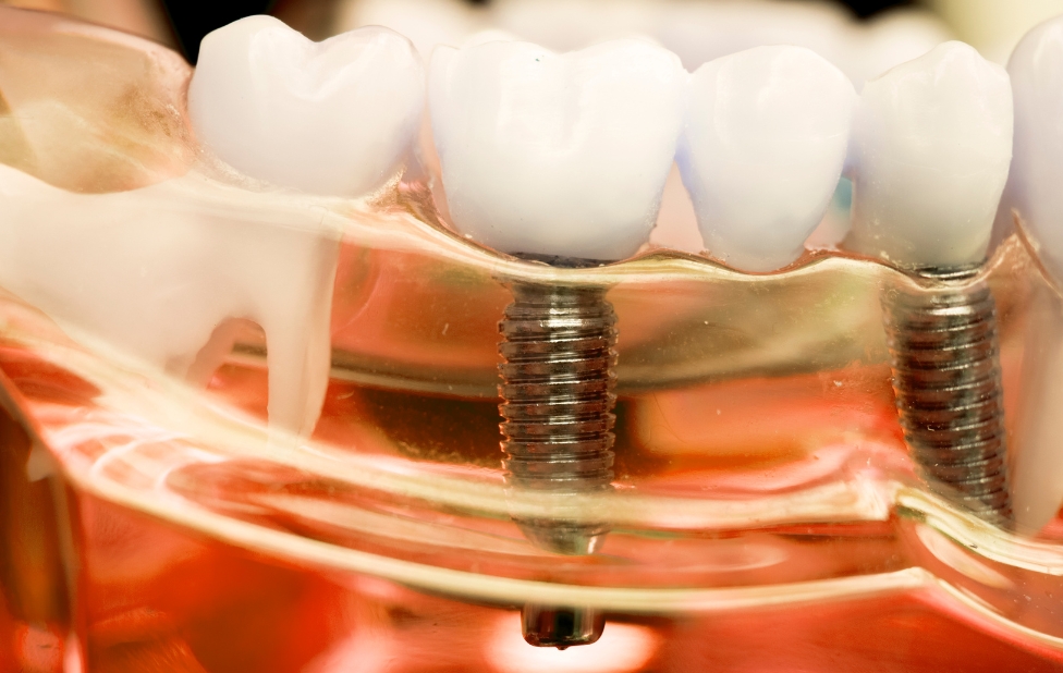 How Dental Implants Restore a Natural Smile