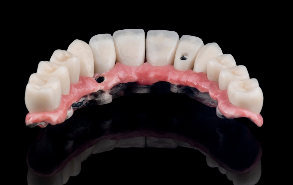 Implants dentaires : à quel âge peut-on en bénéficier ?